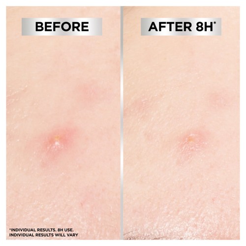 Garnier Pure Active Blemish Patch 
